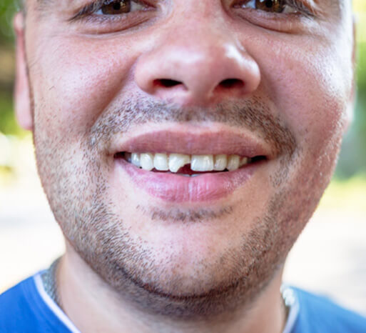 facial closeup of a man with a chipped front upper tooth smiling