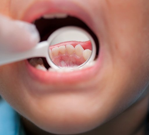 Dental mirror showing back side of child’s teeth